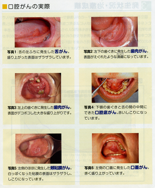 1 口腔がんとは02