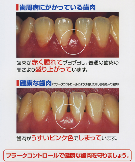 1 あなたは大丈夫？　歯肉のチェック