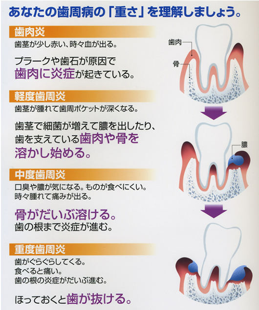 2 知ってる？　歯周病はこんな病気