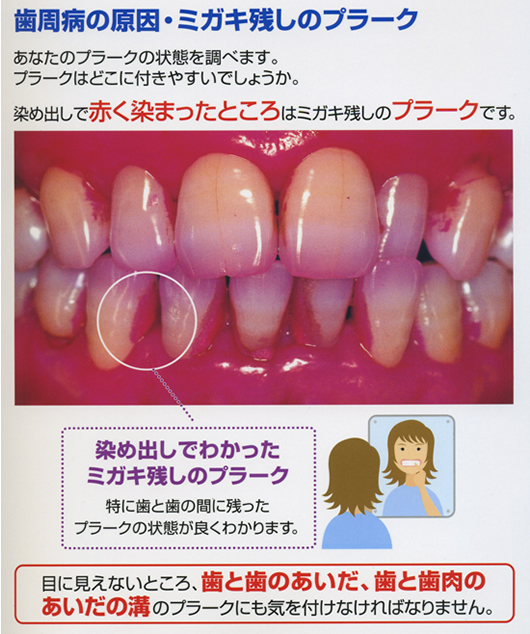 3 なるほど！ 歯周病の原因はプラーク