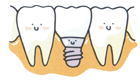 健康な歯を全く削ることなく歯のない部分にインプラントを入れます
