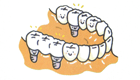 針金付の入れ歯ではなく、歯のない部分に適切な数のインプラントをいれ、固定式の人工歯を取り付けます