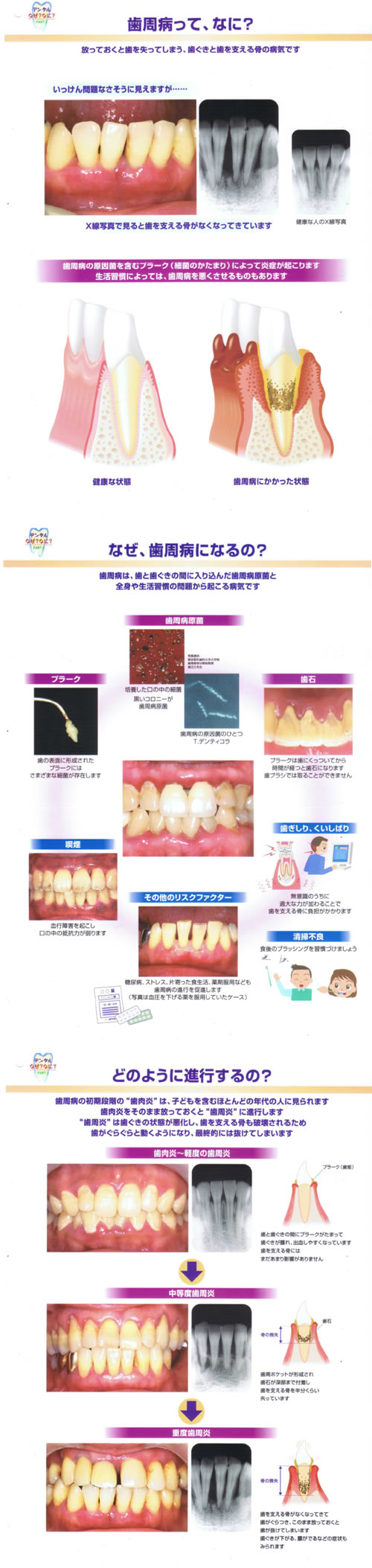 歯周病